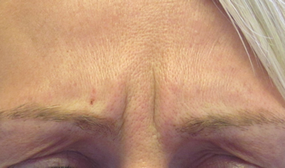 Pre treatment frown lines