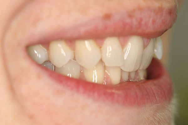 Before Fixed Braces in Chessington Surrey