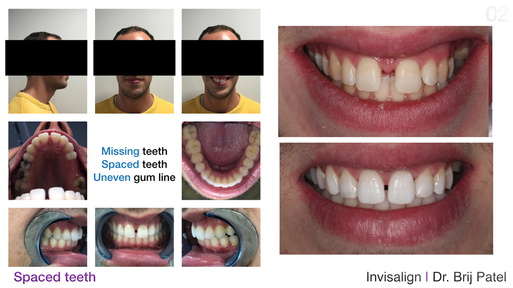Affordable Inivalign near me case study for spaced teeth