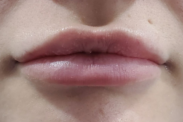 After Lip Fillers in Chessington Surrey