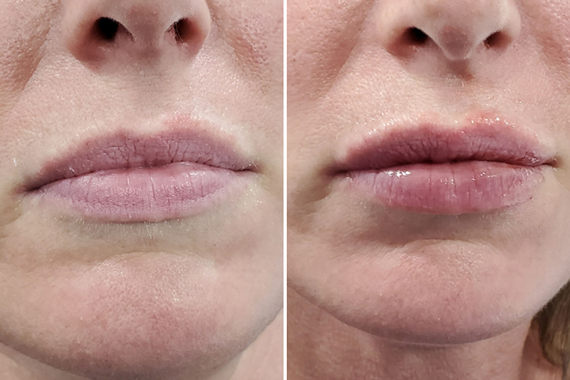 After lip fillers near Kingston Upon Thames