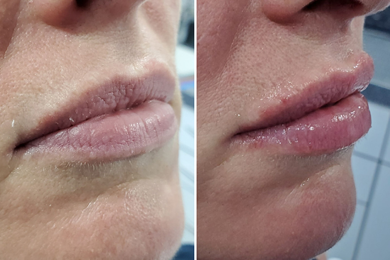 Lip fillers Surrey before and after Juvederm Volift