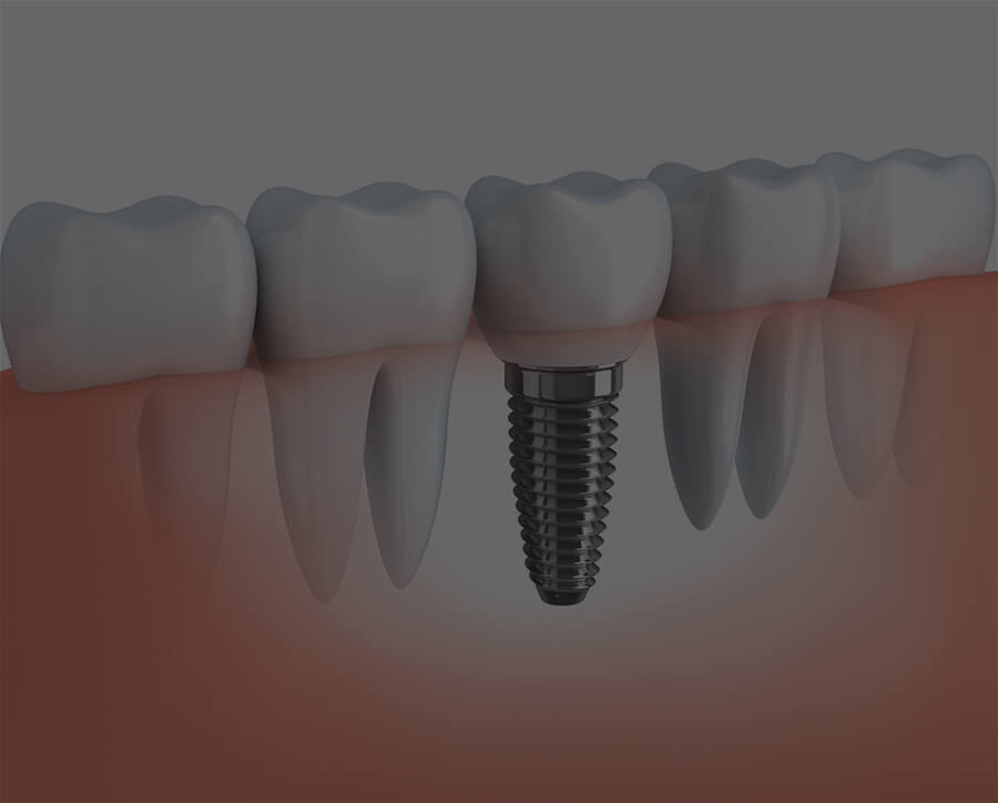 Dental implants Surrey
