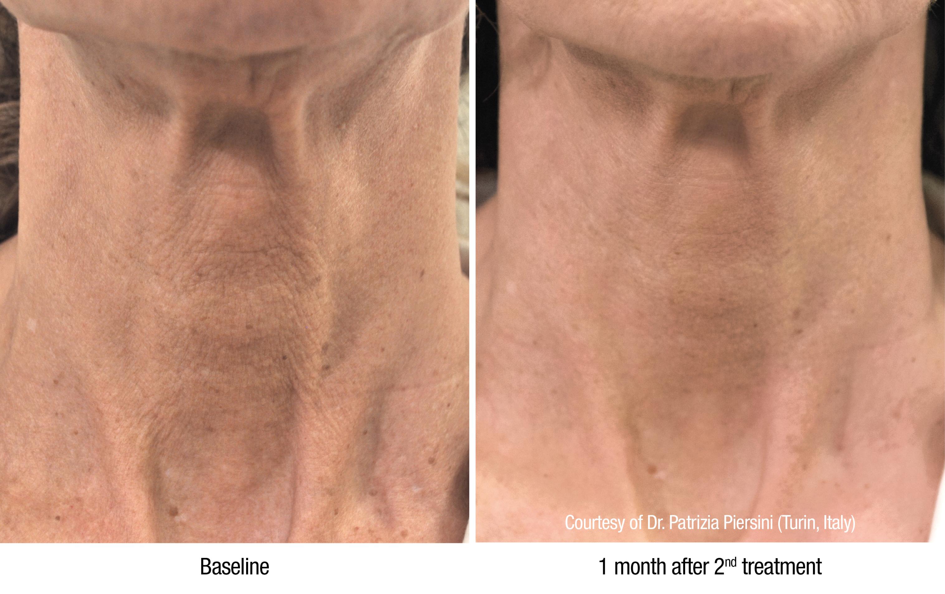 Before and After Profhilo Neck