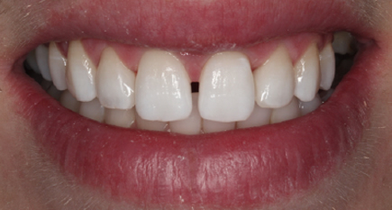 After Whitening and Composite bonding