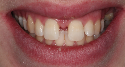 Before Whitening and Composite bonding