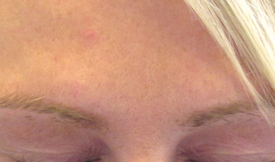 after Botox anti wrinkle injections in Chessington, Surrey