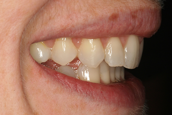 After Fixed Braces in Chessington Surrey
