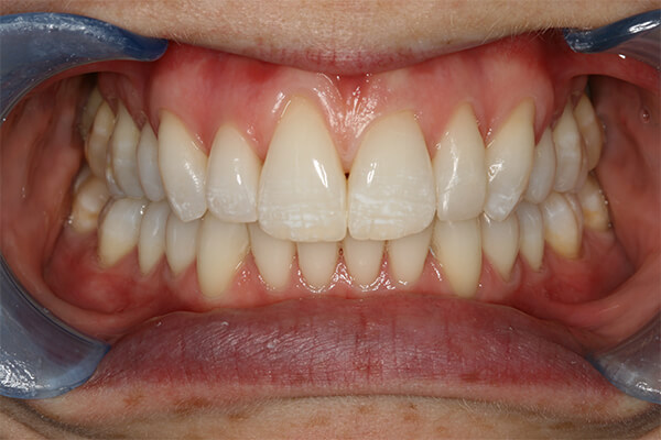 After Invisalign Treatment