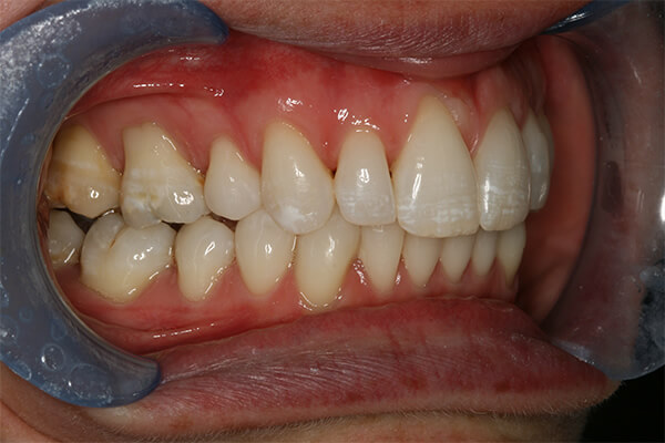 After Invisalign Treatment