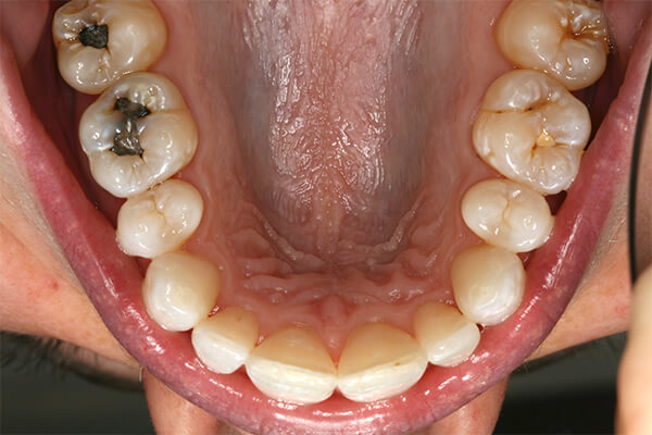 After Invisalign Treatment