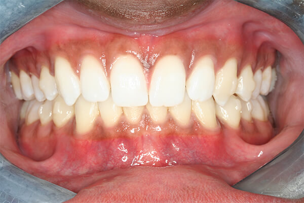 After Invisalign Treatment