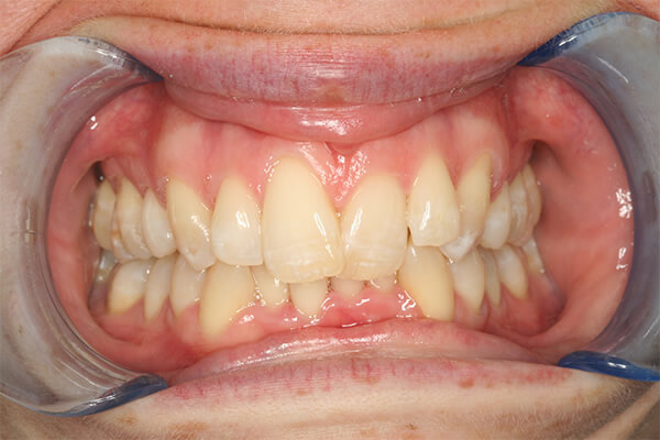 Before Invisalign Treatment