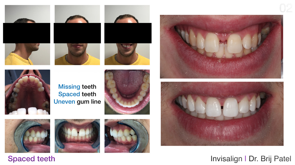Affordable Invisalign near me case study for a Surrey patient
