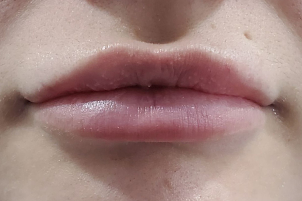 After Lip fillers Kingston upon Thames