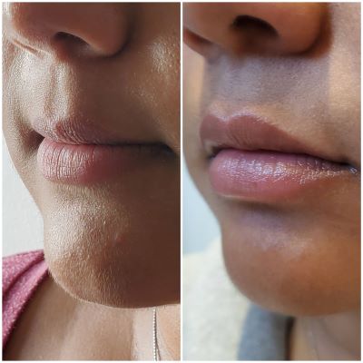 Before after Lip Fillers in Chessington, Surrey