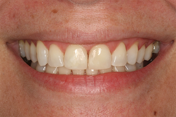 After composite filling treatment