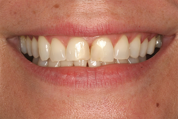 Before composite filling treatment