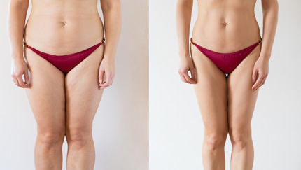 Aqualyx fat dissolving injections near me results